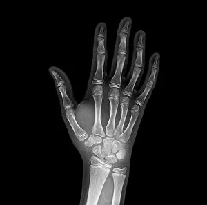Grouper Collection: Broken wrist bone, X-ray C017 / 7187